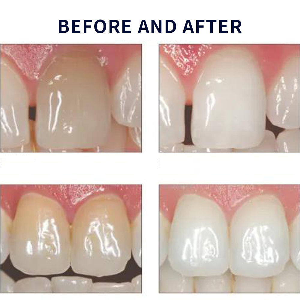 Opalescence Whitening 20% PF 2 – Teeth Whitening Gels Used By Dentists recenzja i cena