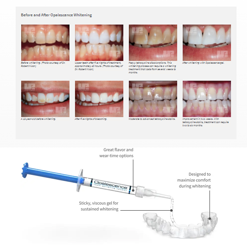 Opalescence Whitening 20% PF 2 – Teeth Whitening Gels Used By Dentists recenzja i cena