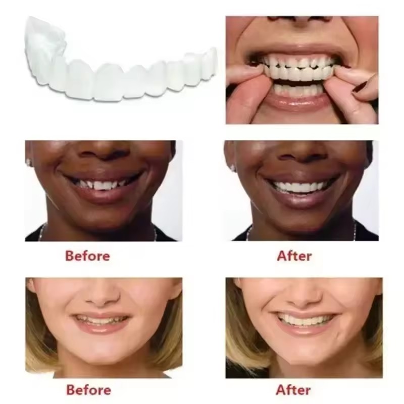 Okładziny na zęby Wybielanie z – Teeth Whitening Procedure recenzja i cena